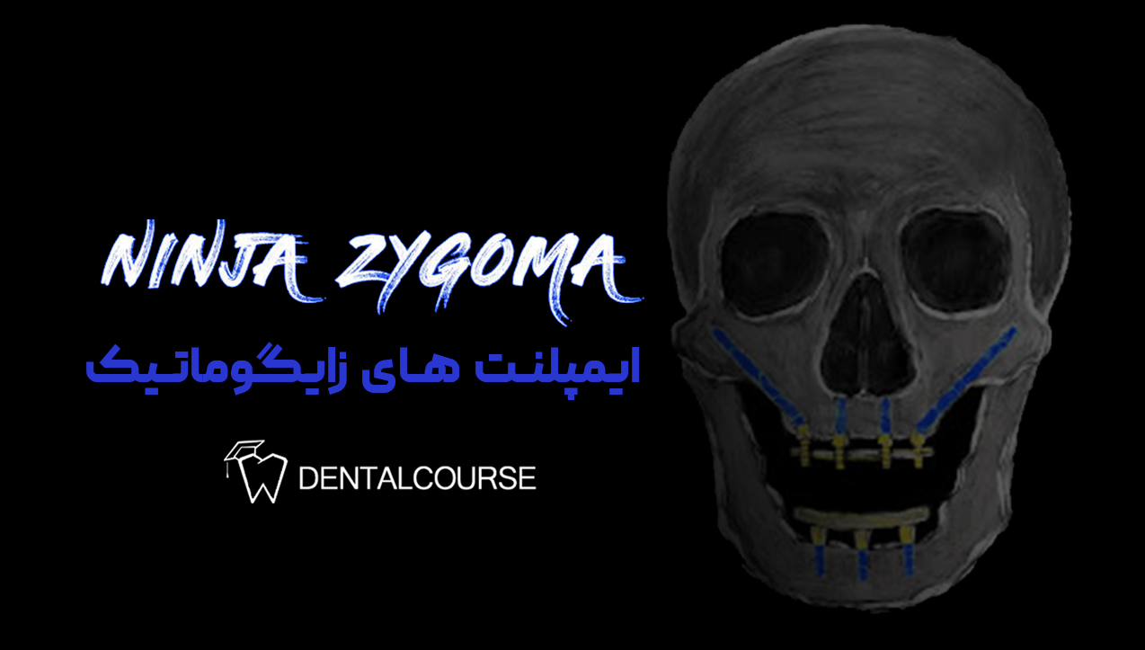 ایمپلنت های زایگوماتیک نینجا